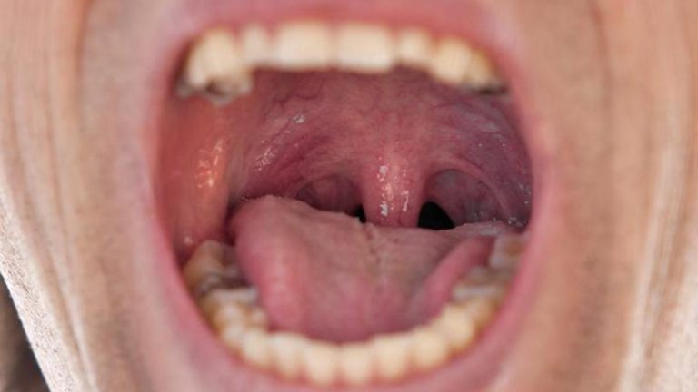 Epiglotun uzaması: nedenleri, belirtileri ve tedavi yöntemleri