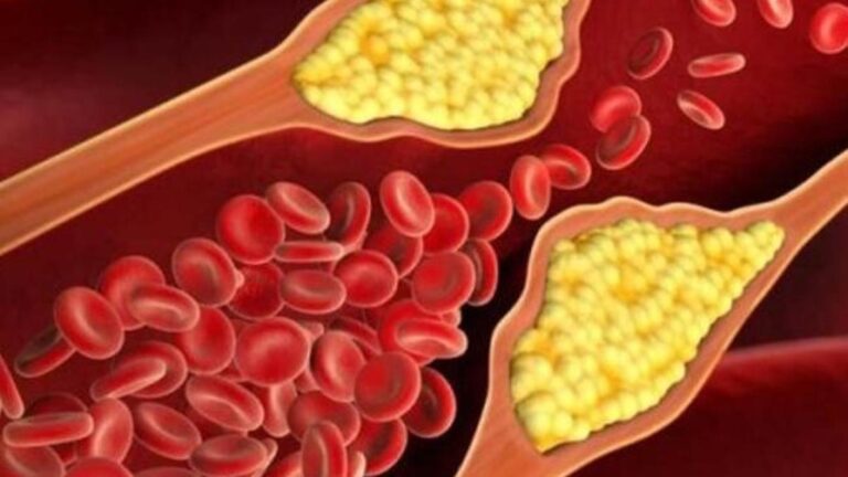 Yüksek kolesterolü etkili bir şekilde azaltmanın yolları