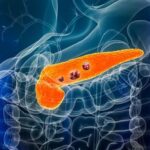 Pankreas kanserinde umut verici ilerleme: ‘Sağ kalım oranı yüzde 54’e ulaştı’